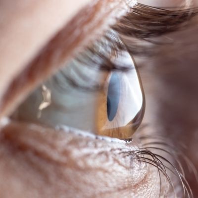 Medizinische Kontaktlinsen korrigieren irreguläre Hornhäute